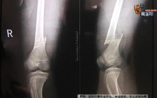 骨折男生踢足球可以吗，骨折男生踢足球可以吗视频